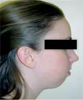 Patient 1 Before with severe chin deficiency 