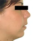 Patient two with chin deficiency before photo