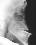Xray of patient 3 protruding lower jaw before surgery