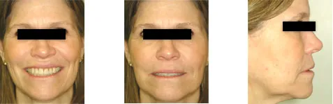 3 photos of patient 4 after treatment of protruding lower jaw and misalignment