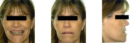 3 photos of patient 4 with jaw misalignment before treatment