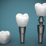 Dental-implants