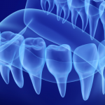 Bone Grafting can help patients replace missing teeth even with severe bone loss.