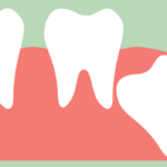 A drawing of an impacted wisdom tooth below the surface of the gum growing at an angle.