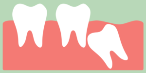 A drawing of an impacted wisdom tooth below the surface of the gum growing at an angle.