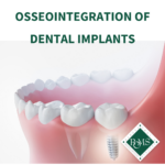 What-is-the-Osseointegration-of-Dental-Implants?