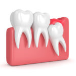 Pericoronitis-Wisdom-Tooth