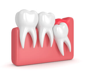 Pericoronitis-Wisdom-Tooth